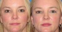 25-34 year old woman treated with Juvederm