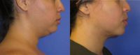 35 year old woman treated with Liposuction of the neck