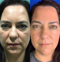 35-44 year old woman treated with Liquid Facelift