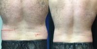 35-44 year old man treated with CoolSculpting