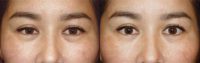 36 year old woman treated with Ptosis Surgery