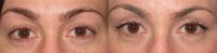 37 year old woman treated with Eyelid Surgery