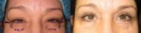 35-44 year old woman treated with Eye Bags Treatment