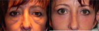 35-44 year old woman treated with Eyelid Surgery & RESET Laser Skin Resurfacing for Eyelid Festoons