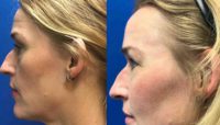 35-44 year old woman treated with Facial Fat Transfer
