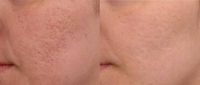 35-44 year old woman treated with Microneedling
