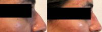 35-44 year old woman treated dorsal hump of nose with Injectable Fillers
