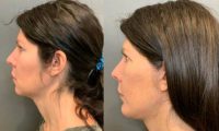 35-44 year old woman treated with Chin Implant
