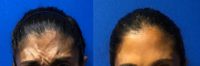 35-44 year old woman treated with Botox (Forehead)