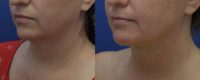 35-44 year old woman treated with Neck Lift