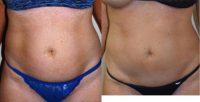 35-44 year old woman treated with Tickle Lipo