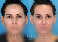 35-44 year old woman treated with Botox
