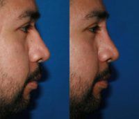 35-44 year old man treated with Nonsurgical Nose Job