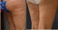 35-44 year old woman treated with Cellulite Treatment