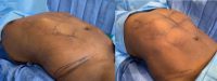 35-44 year old man treated with Abdominal Etching