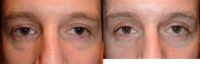 35-44 year old man treated with Lower Eyelid Surgery
