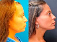 42 year old woman treated with Facelift