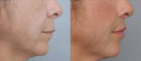 35-44 year old woman treated with Lip Lift