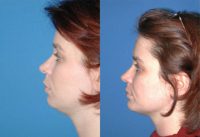 35-44 year old woman treated with Facelift