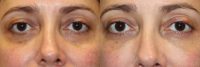 44 year old woman treated with Voluma to the Lower Eyelid Region