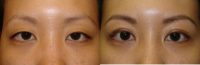 35-44 year old woman treated with Asian Eyelid Surgery
