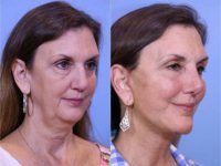 45 - 54 yo year old woman treated with Deep Plane Facelift and Neck Lift