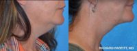 45-54 year old woman treated with Chin Liposuction