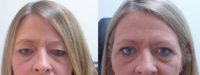 45-54 year old woman treated with Double Eyelid Surgery