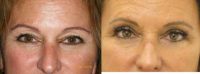 45-54 year old woman treated with Upper Eyelid Surgery and Laser Resurfacing of the lower eyelids