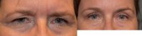 45-54 year old woman treated with Brow Lift