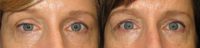 45-54 year old woman treated with Cosmetic Eyelid Surgery