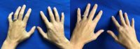 45-54 year old woman treated with Hand Rejuvenation (Fillers)
