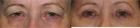 45-54 year old woman Blepharoplasty