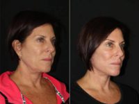 45-54 year old woman treated with Facelift, Revision Neck Lift, CO2 Laser, PRP