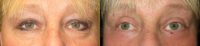 45-54 year old woman treated with Eye Bags Treatment (staged)