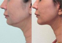 48 year old woman treated with Lower Facelift and Chin Augmentation (silicone implant)