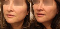 45-54 year old woman who underwent Revision Rhinoplasty with removal of Nasal Implant