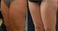 45-54 year old woman treated with Cellulite Treatment