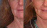 45-54 year old woman treated with Lower Face Lift