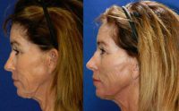 45-54 year old woman treated with Non Surgical Face Lift - Silhouette InstaLift