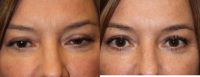 45-54 year old woman treated with Ptosis Surgery to help droopy upper eyelids