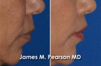 45-54 year old woman treated with Lip Lift