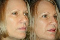 45-54 year old woman treated with Non Surgical Nose Job