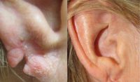 45-54 year old woman Ear Lobe Repair