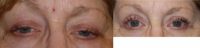 54 year old woman treated with Ptosis Surgery