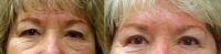 55-64 year old woman treated with blepharoplasty and left ptosis repair