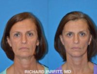 55-64 year old woman treated with Facelift and Blepharoplasty