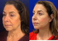 57 year old woman treated with Facial Fat Transfer