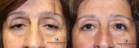 55-64 year old woman treated with Ptosis Surgery and Mole Removal (Edge of Right Upper Eyelid)