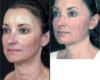 55-64 year old woman treated with Facelift, fat injections